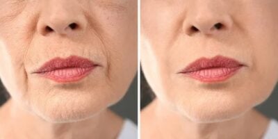 Imagem do post Mais potente que Botox: Mistura com 3 ingredientes some com as rugas e traz pele de seda em 15 minutos
