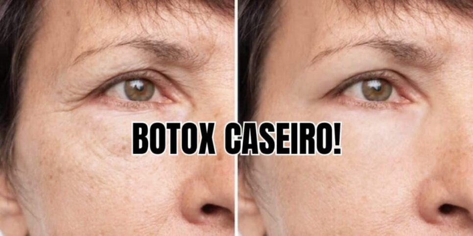 Botox caseiro dexa você 20 mais jovem e com pele mais linda que das famosas - Foto: Internet