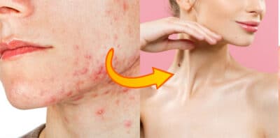 Adeus acne e espinhas com essa receitinha (Foto: Divulgação)