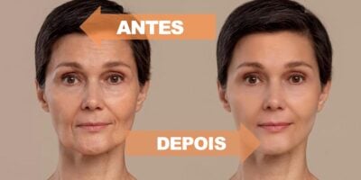 Imagem do post Mais potente que harmonização facial: 2 ingredientes sugam as rugas e aumentam 100% do colágeno