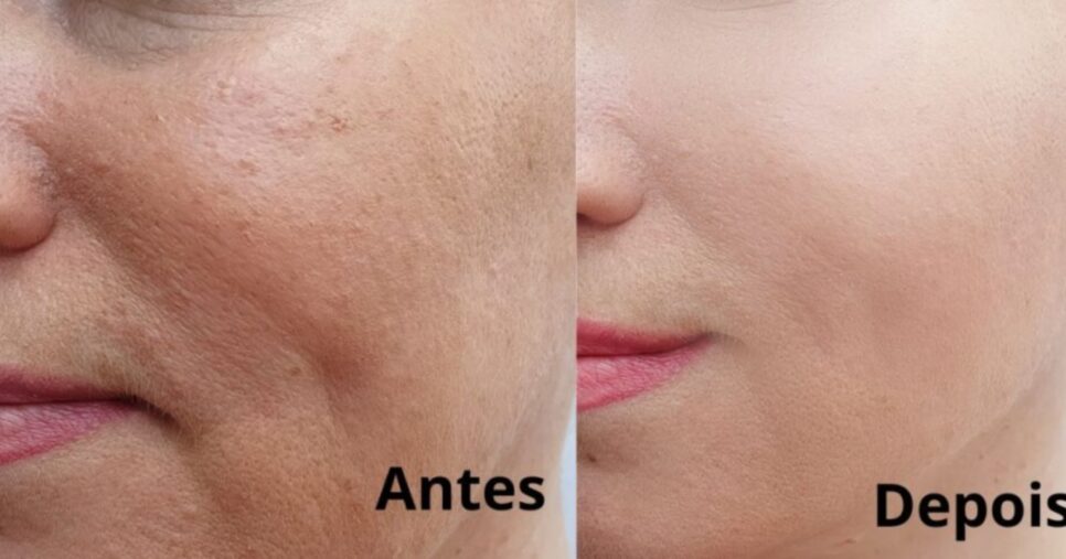 3 receitas de harmonização facial caseira que dão fim às rugas e rejuvenesce às 50+ em minutos - Foto: Internet