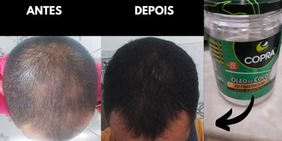 Calvície antes e depois da aplicação do óleo de coco (Foto Reprodução/Montagem/YouTube)