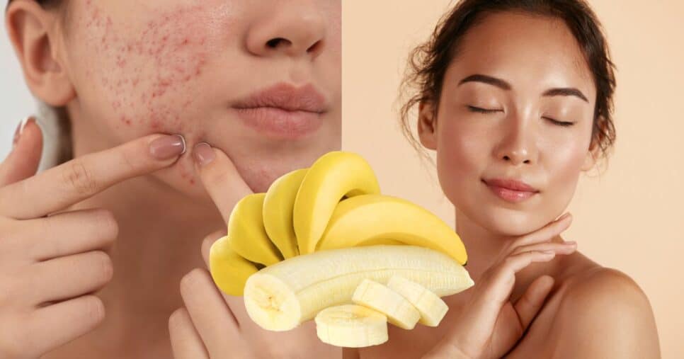 Limpeza facial caseira com banana remove cravos e espinhas (Reprodução/Montagem TV Foco/Canva)