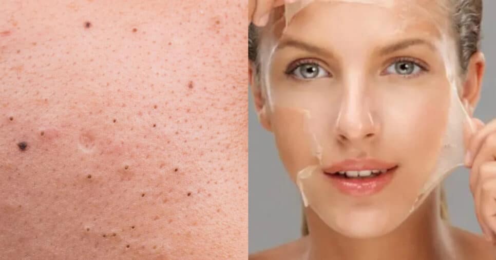 Cravos e espinhas vão acabar com o peeling caseiro (Foto: Montagem)